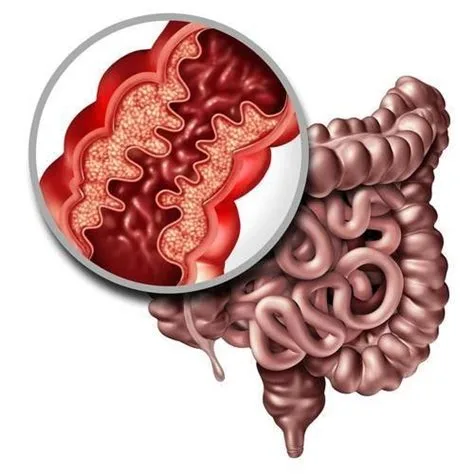 Association maladie de crohn Association maladie de crohn
