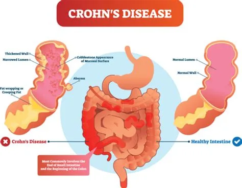 Biopsie maladie de crohn Biopsie maladie de crohn