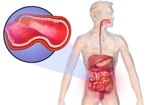 Crise maladie de crohn Crise maladie de crohn