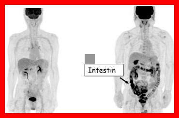Comment la metformine agit-elle sur le corps Comment la metformine agit-elle sur le corps