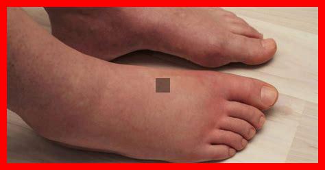 L’amlodipine peut-elle causer des pieds enflés L'amlodipine peut-elle causer des pieds enflés