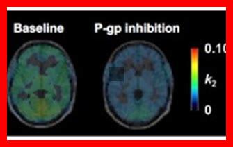 Quels témoignages de patients sur le Métoclopramide existent Quels témoignages de patients sur le Métoclopramide existent
